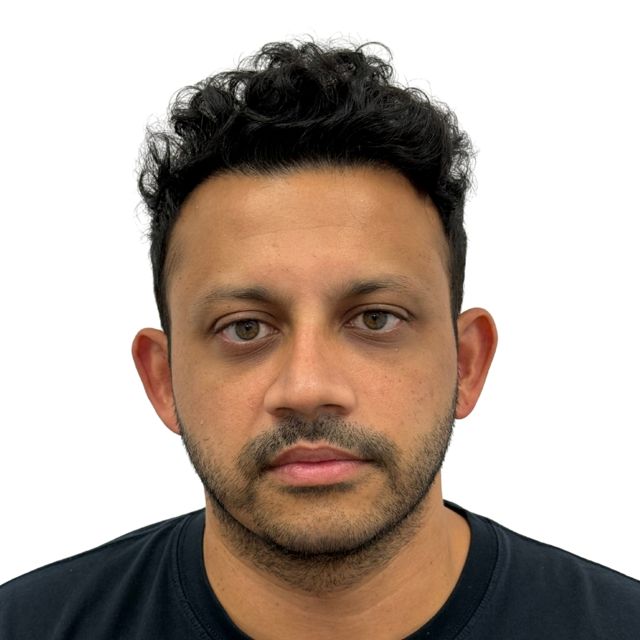 Hairline Clinic patient after hair transplant
