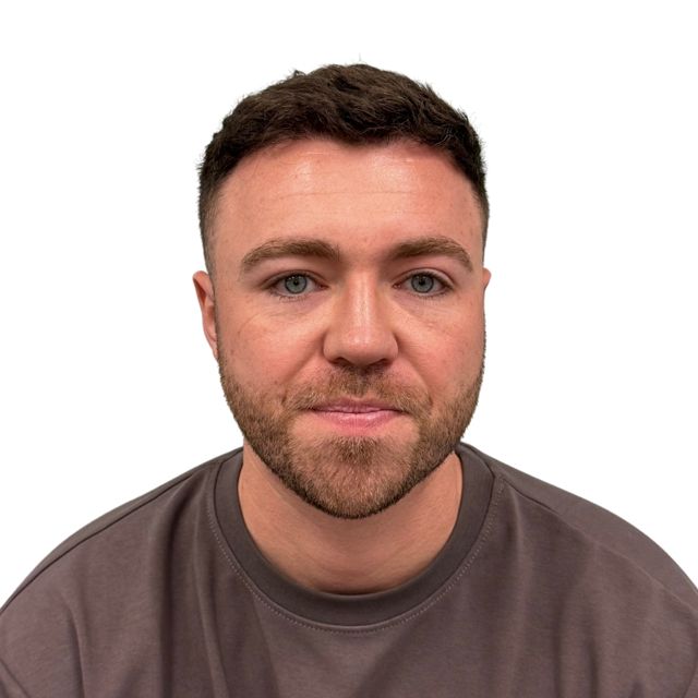 Hairline Clinic patient after hair transplant