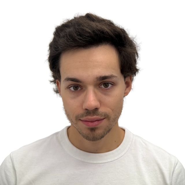 Hairline Clinic patient after hair transplant