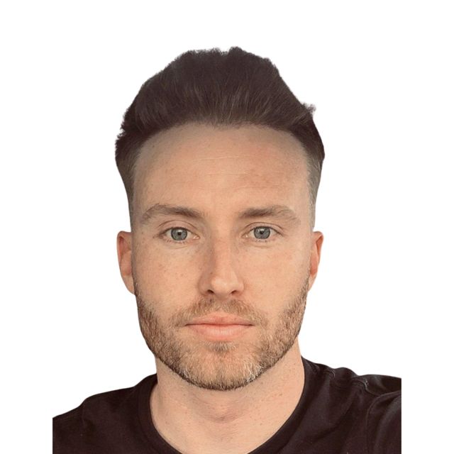 Hairline Clinic patient after hair transplant