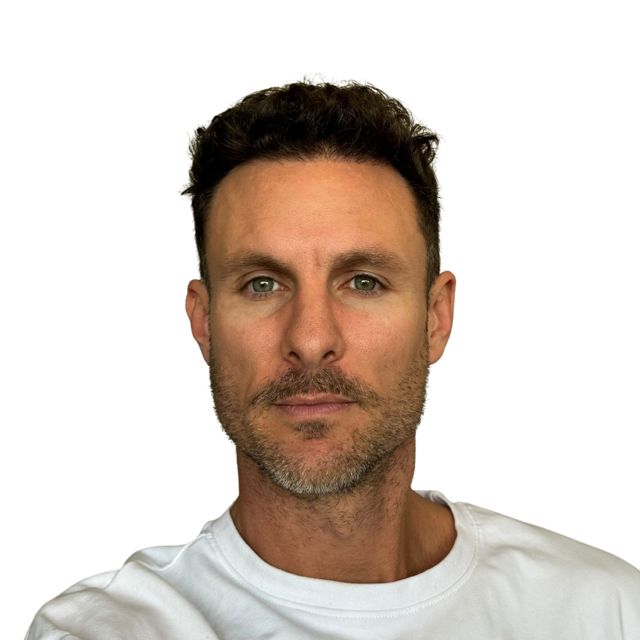 Hairline Clinic patient after hair transplant