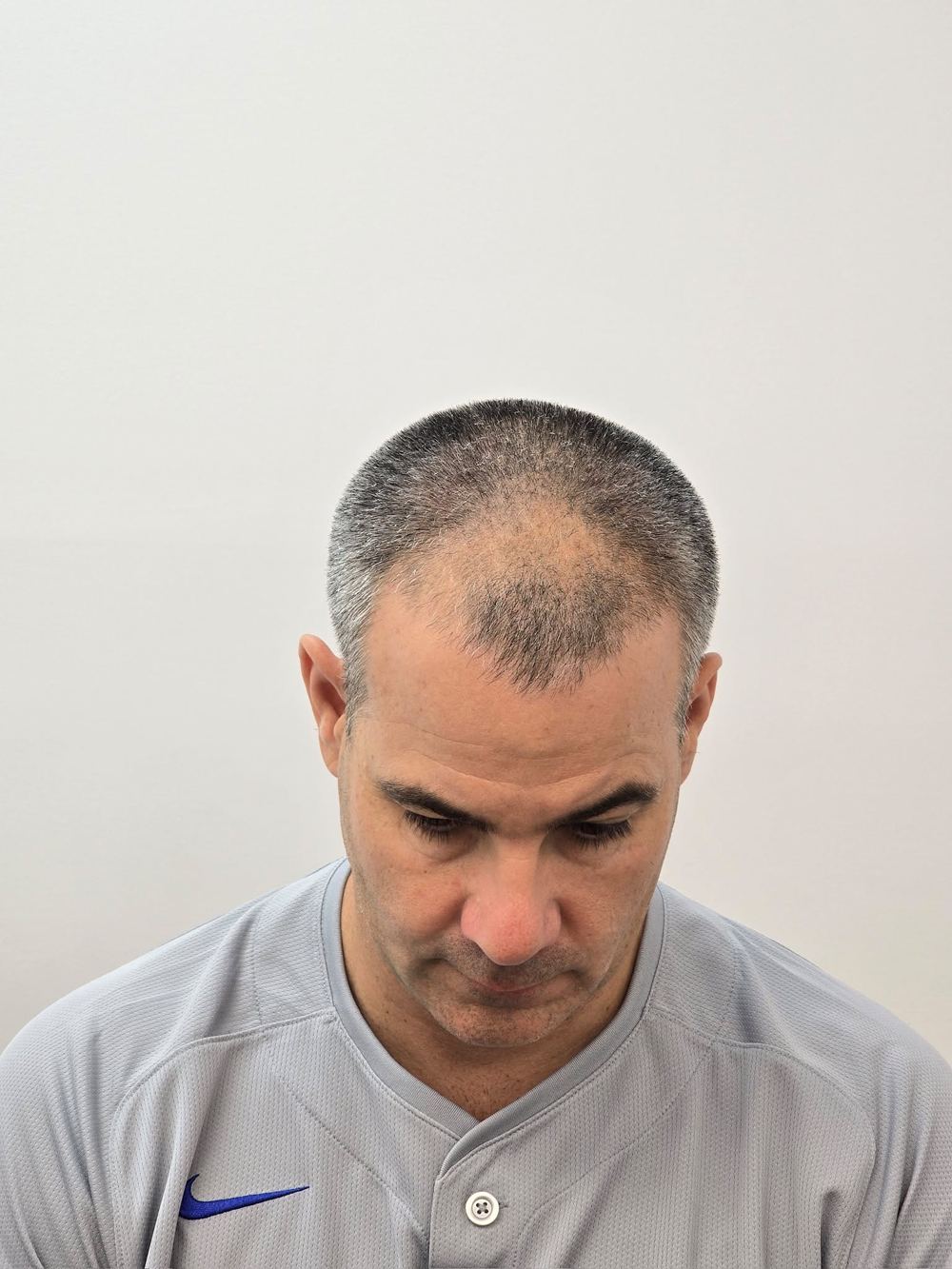 Patient before FUE, front view showing frontal and crown thinning