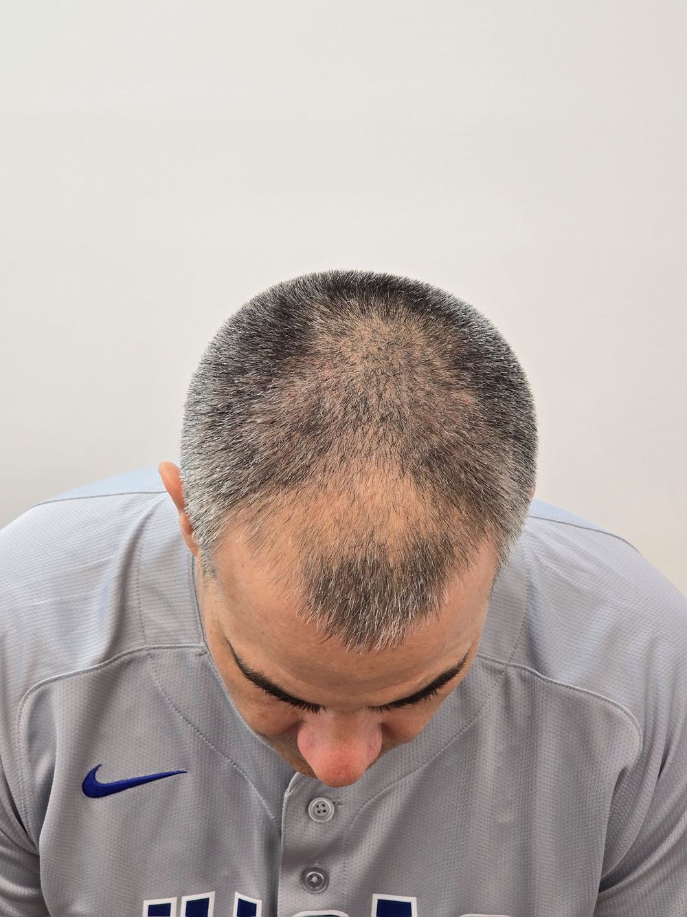 Crown before procedure, top view