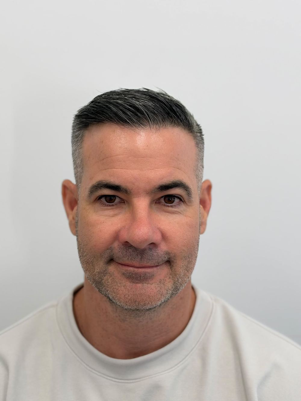 Same patient after FUE, front view