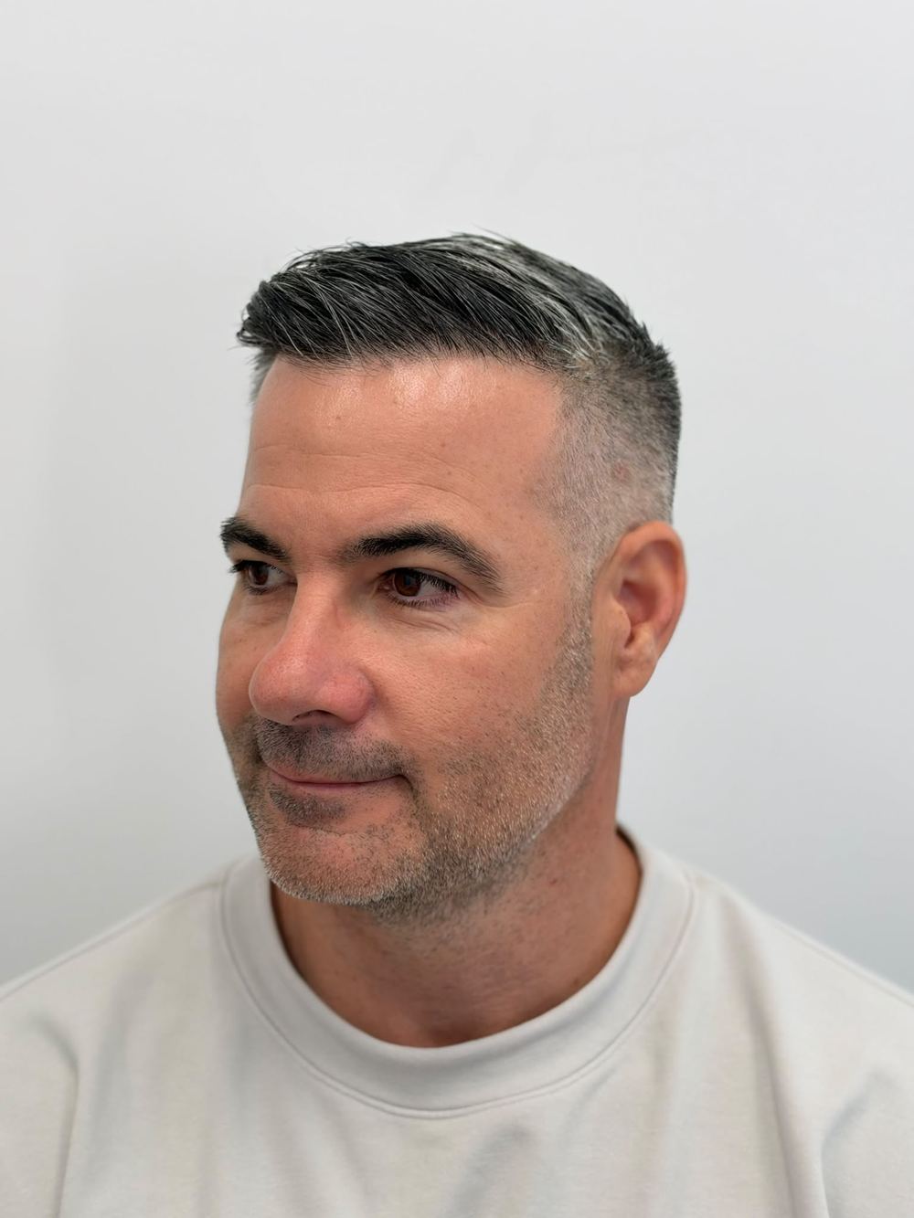 Same patient after procedure, side view