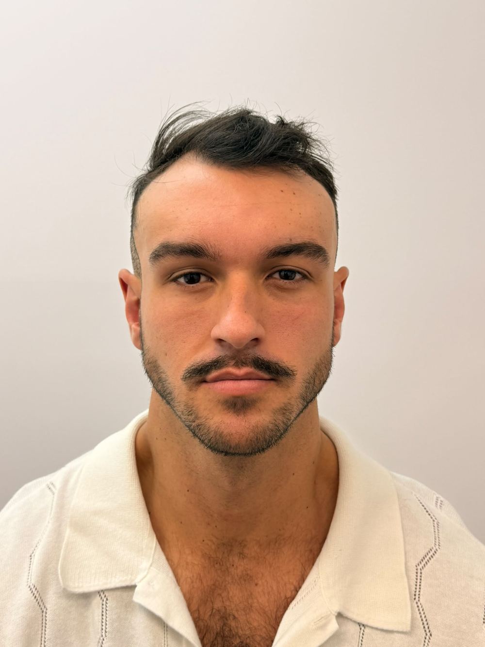 Temporal recession before procedure, front view