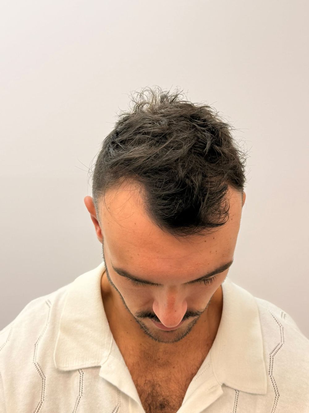 Temporal recession before procedure, top view
