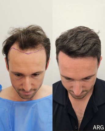 Before and after FUE, top view, hairline and frontal zone