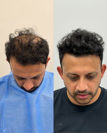 Before and after FUE, top view, diffuse frontal thinning